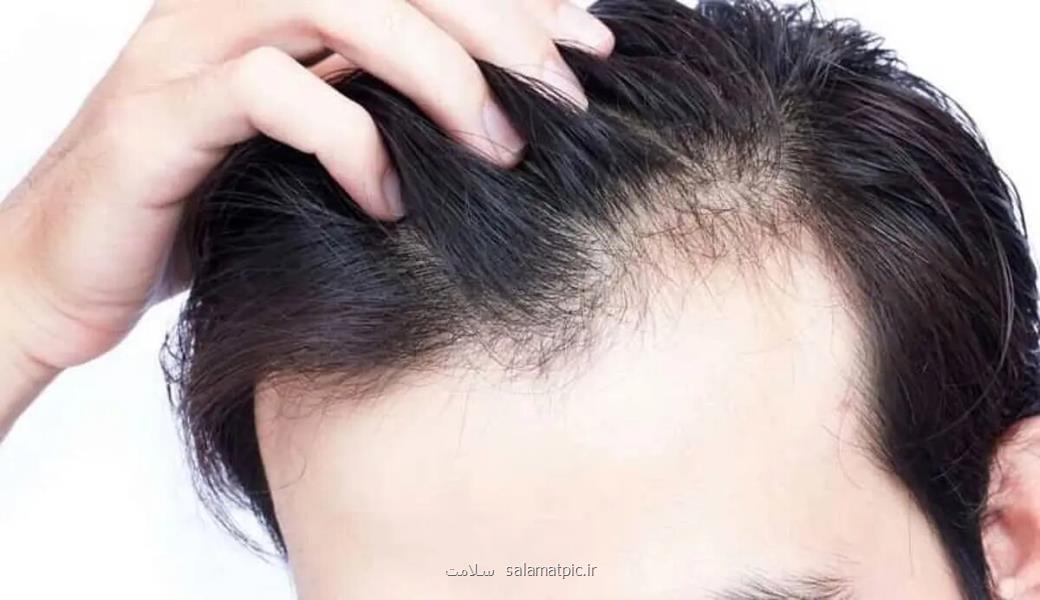اختلال در این اندام های بدن سبب ریزش موی سر می شود