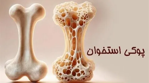 پوکی استخوان در کودکان، واقعیتی فراموش شده