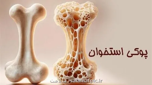 پوکی استخوان در کودکان، واقعیتی فراموش شده